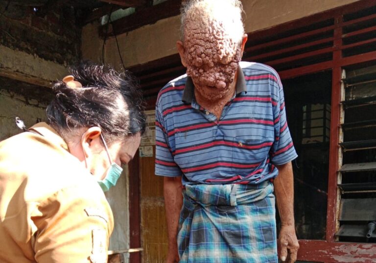 Meski RPL Penuh, Pemkot Mojokerto Tetap Fasilitasi Penanganan Mbah Rofii
